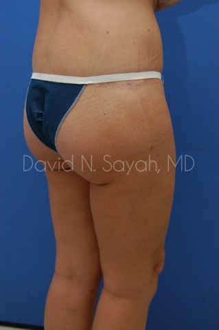 Body Lift Before and After | Sayah Institute