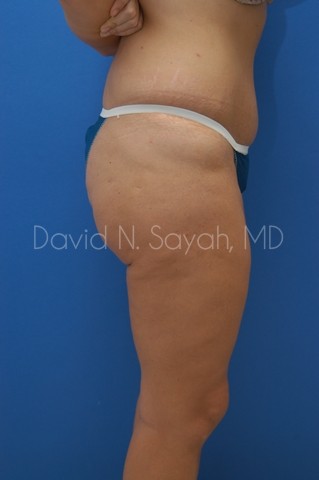 Body Lift Before and After | Sayah Institute