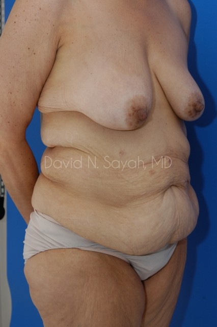 Body Lift Before and After | Sayah Institute