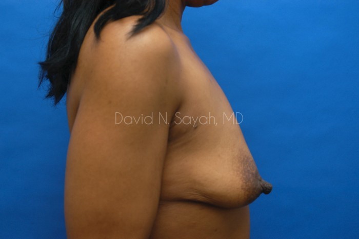 Breast Augmentation And Mastopexy Before and After | Sayah Institute