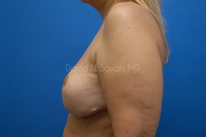 Breast Augmentation And Mastopexy Before and After | Sayah Institute