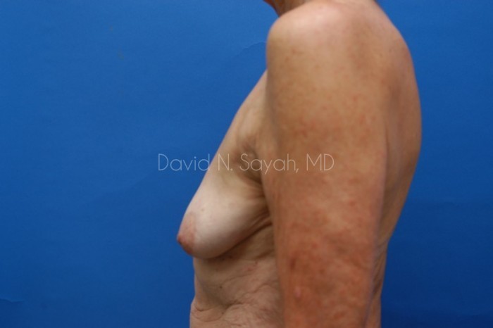 Breast Augmentation And Mastopexy Before and After | Sayah Institute