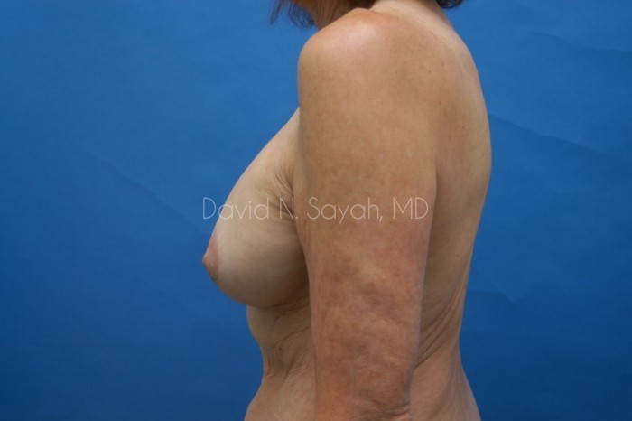 Breast Augmentation And Mastopexy Before and After | Sayah Institute