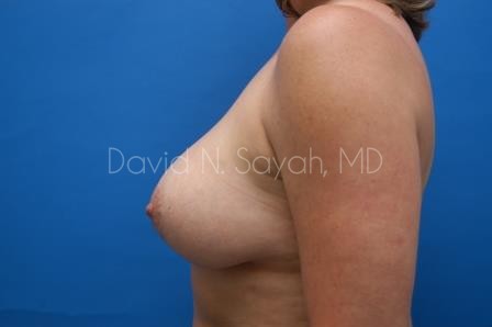 Breast Augmentation And Mastopexy Before and After | Sayah Institute
