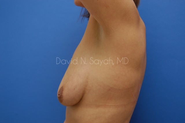 Breast Augmentation And Mastopexy Before and After | Sayah Institute