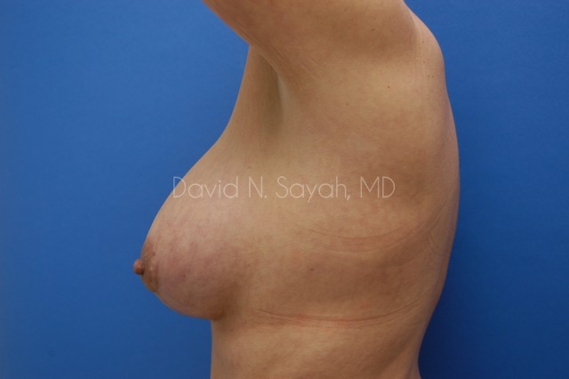 Breast Augmentation And Mastopexy Before and After | Sayah Institute