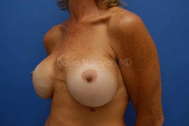 Breast Augmentation And Mastopexy Before and After | Sayah Institute