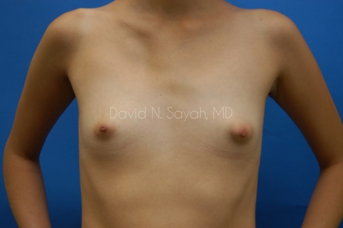 Breast Augmentation Before and After | Sayah Institute