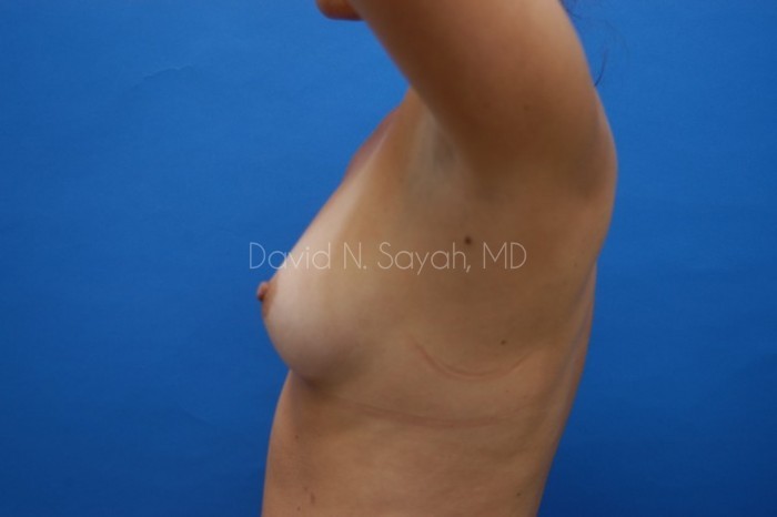 Breast Augmentation Before and After | Sayah Institute