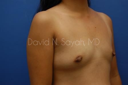 Breast Augmentation Before and After | Sayah Institute