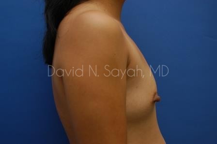 Breast Augmentation Before and After | Sayah Institute