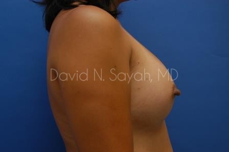 Breast Augmentation Before and After | Sayah Institute