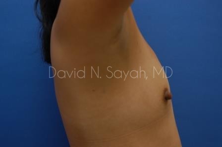 Breast Augmentation Before and After | Sayah Institute