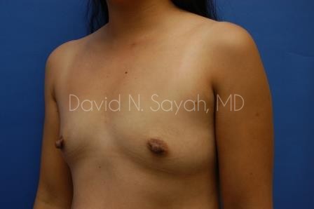 Breast Augmentation Before and After | Sayah Institute
