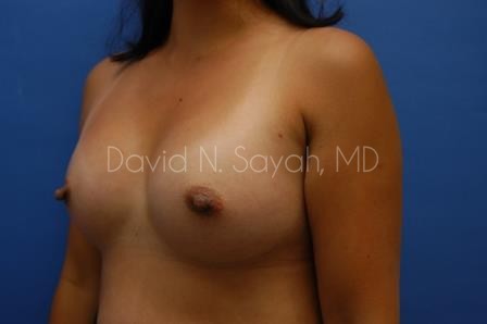 Breast Augmentation Before and After | Sayah Institute