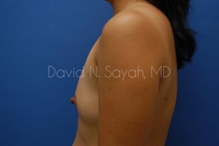 Breast Augmentation Before and After | Sayah Institute