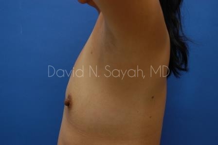 Breast Augmentation Before and After | Sayah Institute