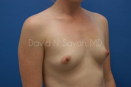 Breast Augmentation Before and After | Sayah Institute