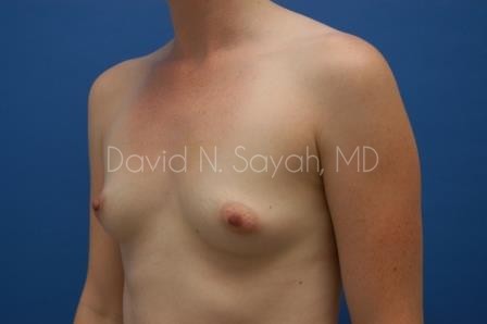 Breast Augmentation Before and After | Sayah Institute