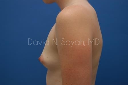 Breast Augmentation Before and After | Sayah Institute