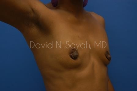 Breast Augmentation Before and After | Sayah Institute