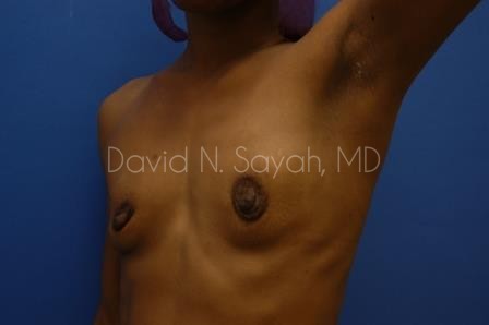 Breast Augmentation Before and After | Sayah Institute