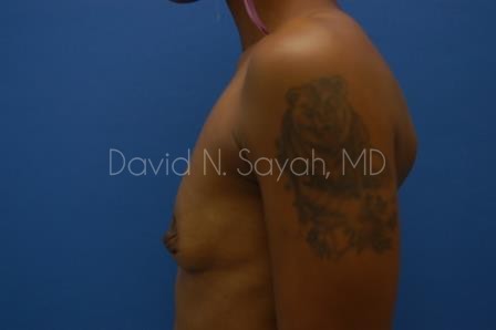 Breast Augmentation Before and After | Sayah Institute