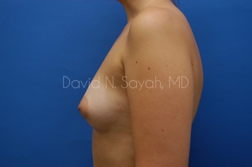 Breast Augmentation Before and After | Sayah Institute
