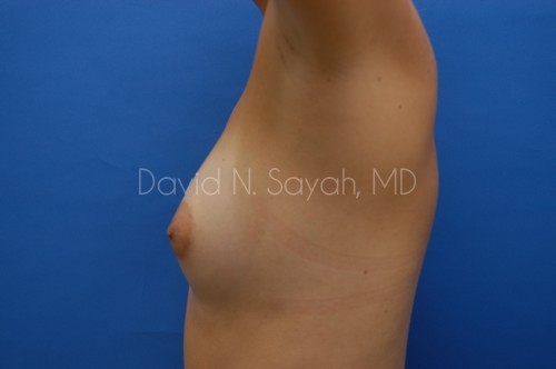 Breast Augmentation Before and After | Sayah Institute