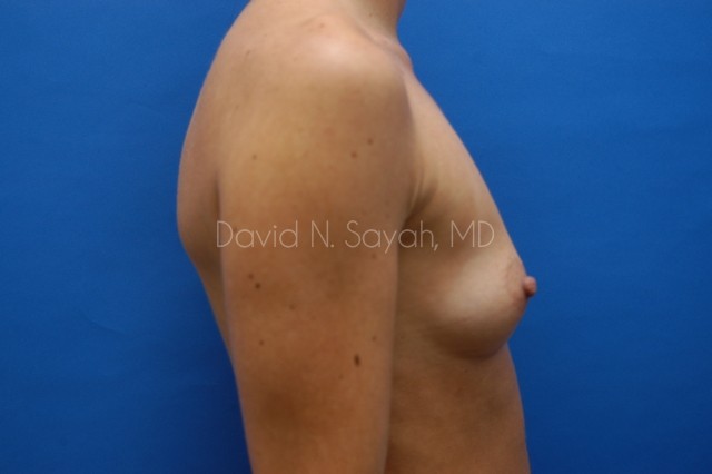 Breast Augmentation Before and After | Sayah Institute
