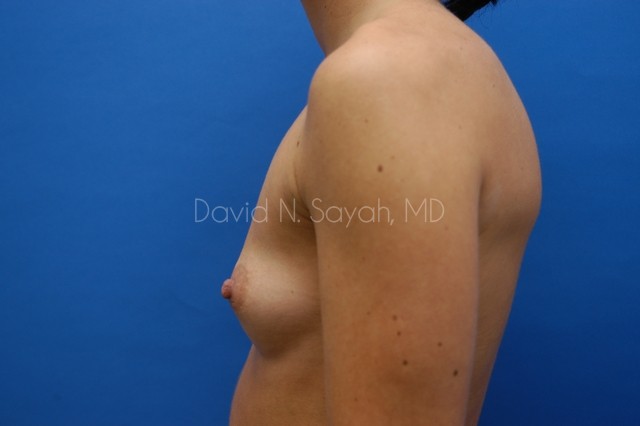 Breast Augmentation Before and After | Sayah Institute