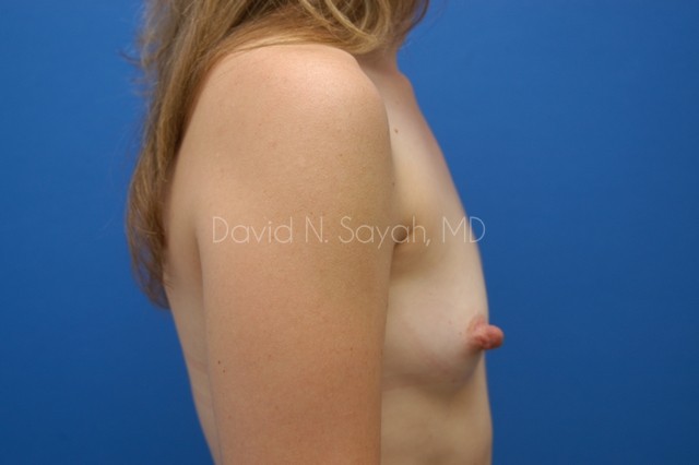 Breast Augmentation Before and After | Sayah Institute