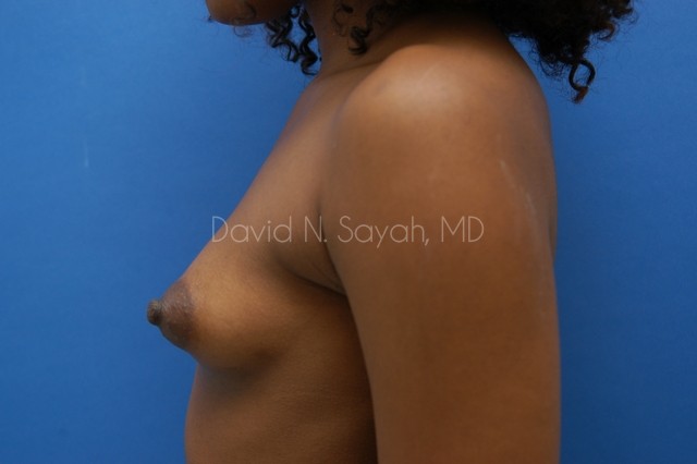 Breast Augmentation Before and After | Sayah Institute