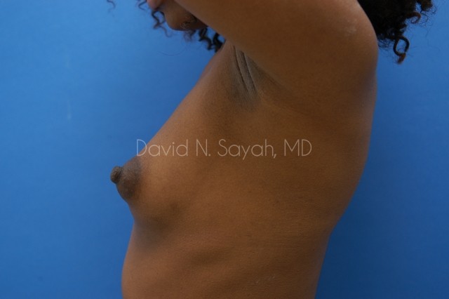 Breast Augmentation Before and After | Sayah Institute