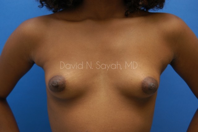 Breast Augmentation Before and After | Sayah Institute