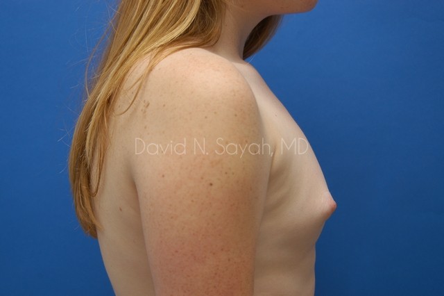 Breast Augmentation Before and After | Sayah Institute