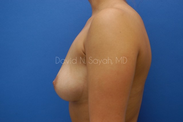 Breast Augmentation Before and After | Sayah Institute