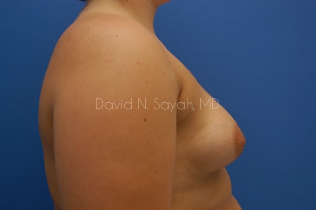Breast Augmentation Before and After | Sayah Institute