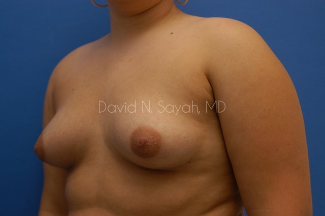 Breast Augmentation Before and After | Sayah Institute