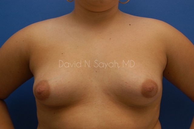 Breast Augmentation Before and After | Sayah Institute