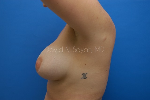Breast Augmentation Before and After | Sayah Institute
