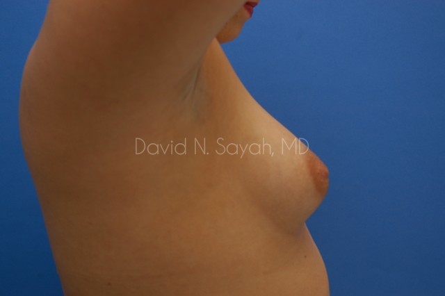 Breast Augmentation Before and After | Sayah Institute