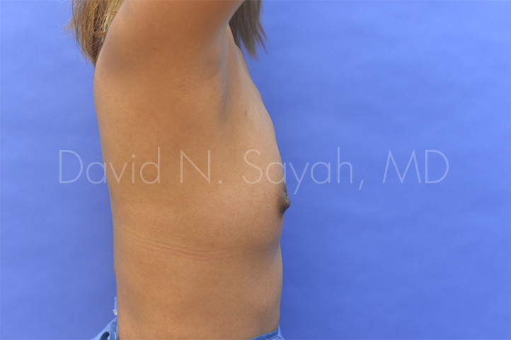 Breast Augmentation Before and After | Sayah Institute