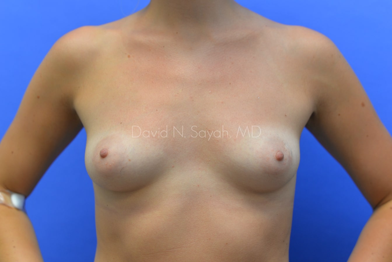 Breast Augmentation Before and After | Sayah Institute