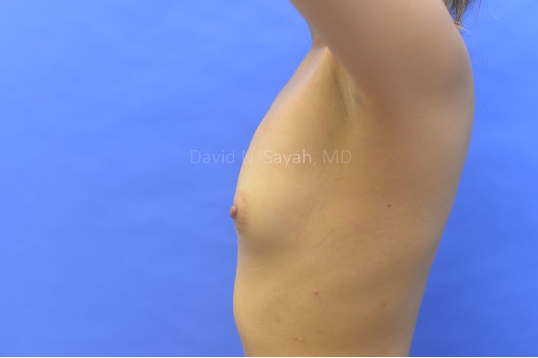 Breast Augmentation Before and After | Sayah Institute