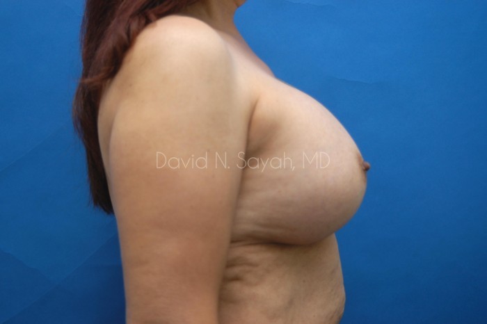 Breast Implant Exchange Before and After | Sayah Institute
