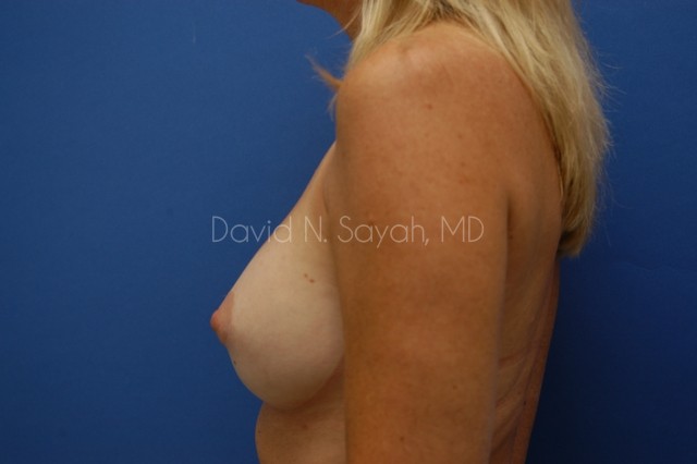 Breast Implant Exchange Before and After | Sayah Institute