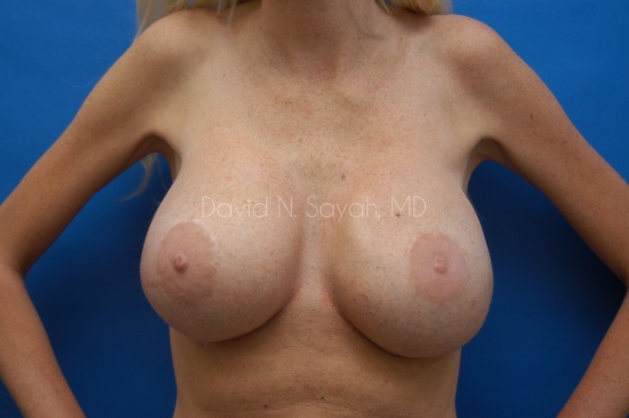 Breast Implant Revision Before and After | Sayah Institute