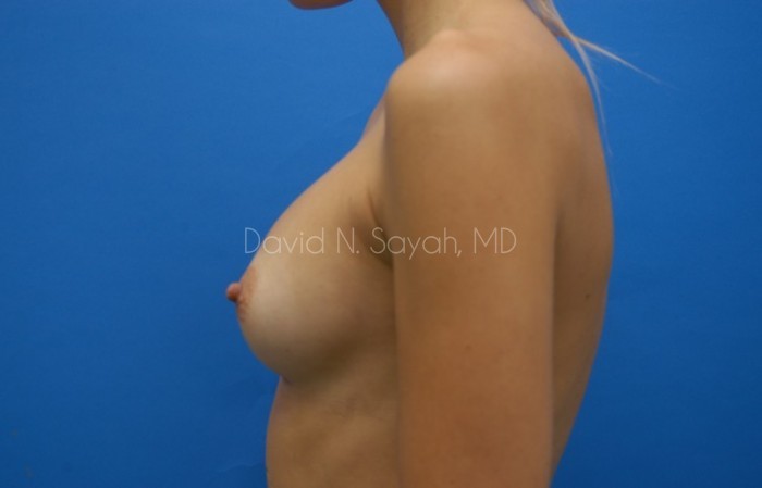 Breast Implant Revision Before and After | Sayah Institute