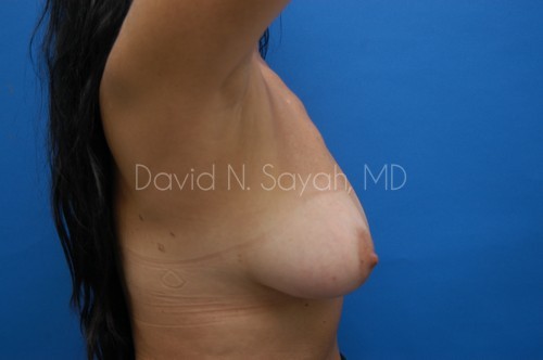 Breast Implant Revision Before and After | Sayah Institute
